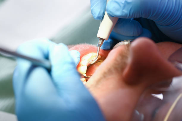 Best Emergency Dental Extractions in Cheat Lake, WV