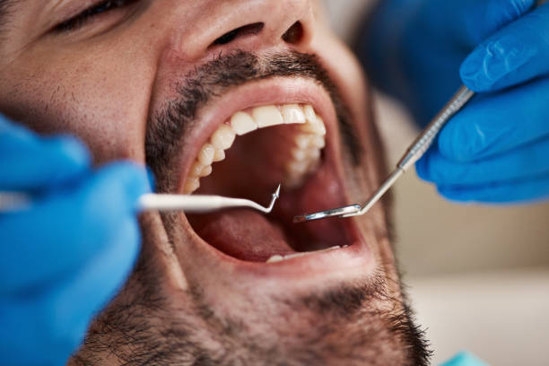 Best Emergency Dentist for Knocked-Out Tooth in Cheat Lake, WV